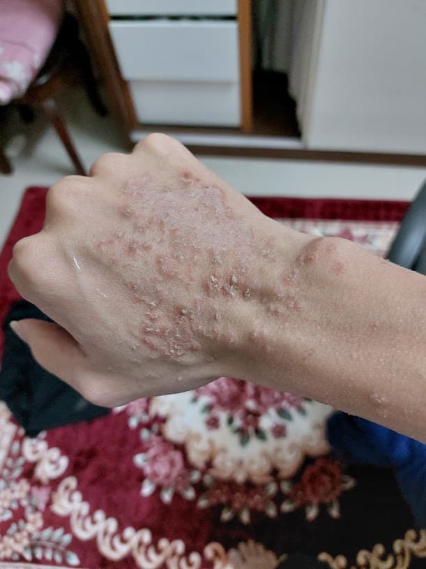 Ban tay - Truoc dieu tri